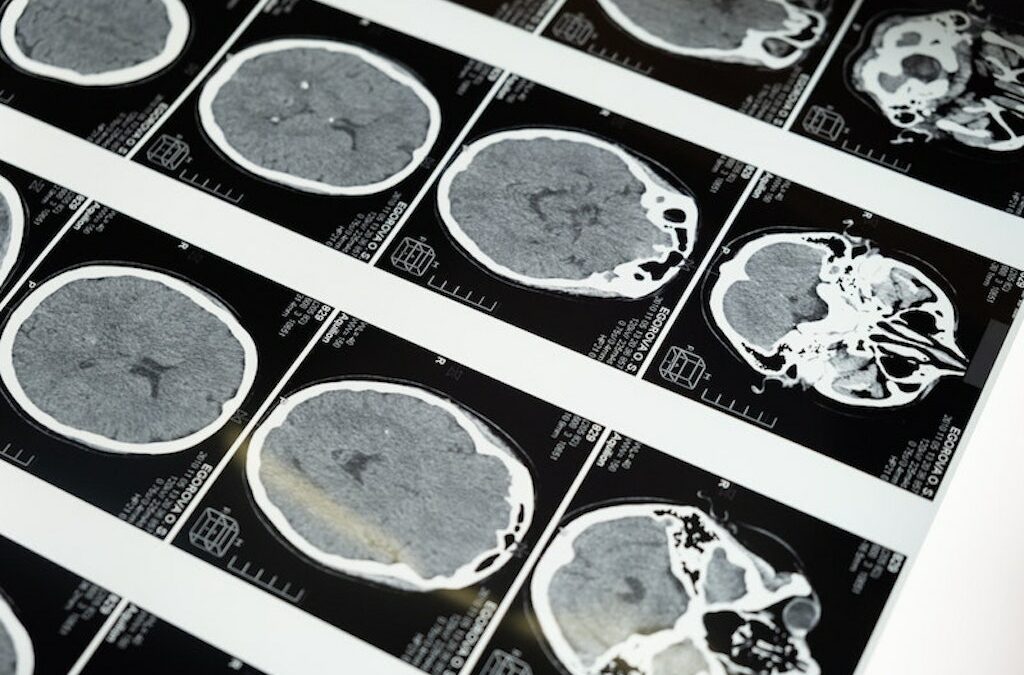 La medicina può prevedere l’ansia con l’analisi della materia grigia