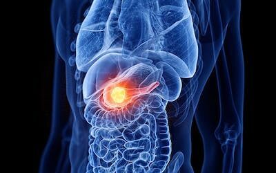 Cancro al pancreas, studio italiano individua chiave dello sviluppo