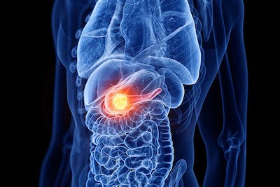 tumore-pancreas-traguardi-ricercatori-fondazione-airc